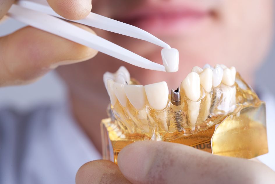 Krok po kroku: Proces instalacji implantów zębowych w Gdańsku